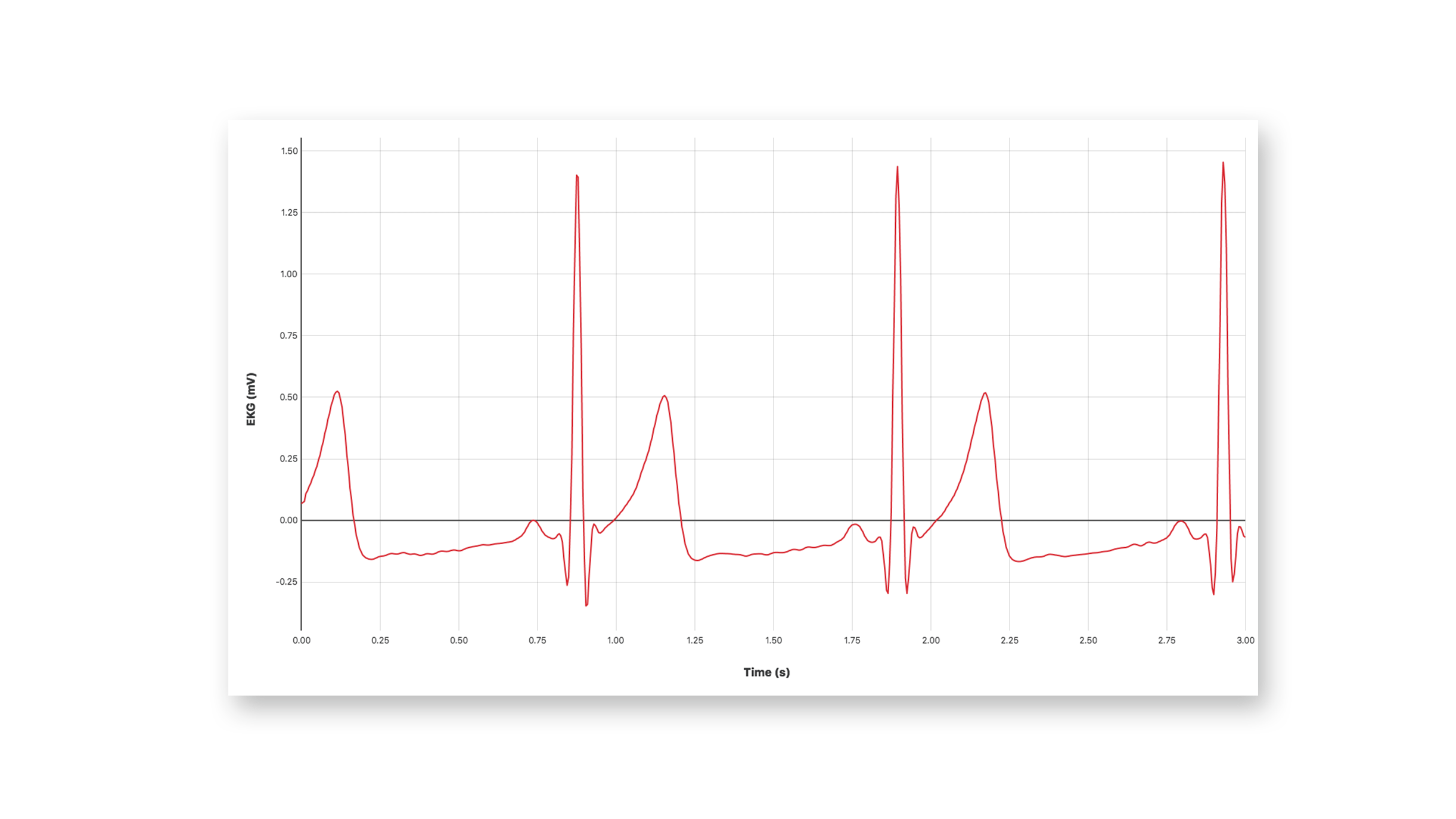 EKG recordings