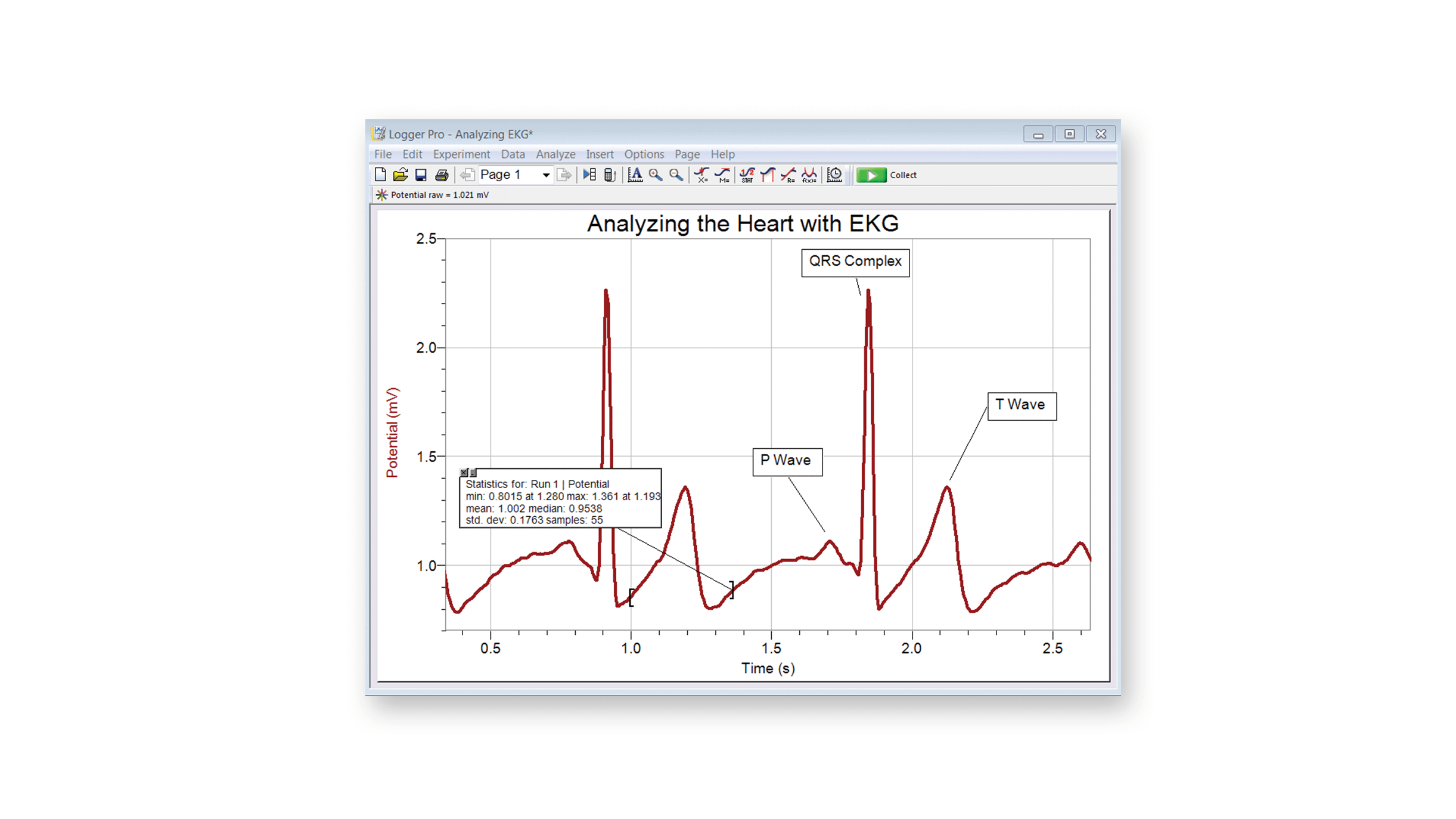 EKG graph demonstrating the electrical events that happen during contraction of the heart's chambers
